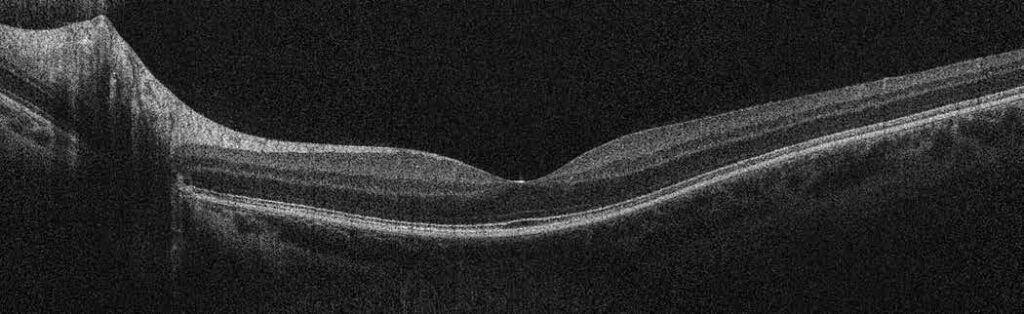 Wide-field image of human retina, courtesy of James Fujimoto, MIT