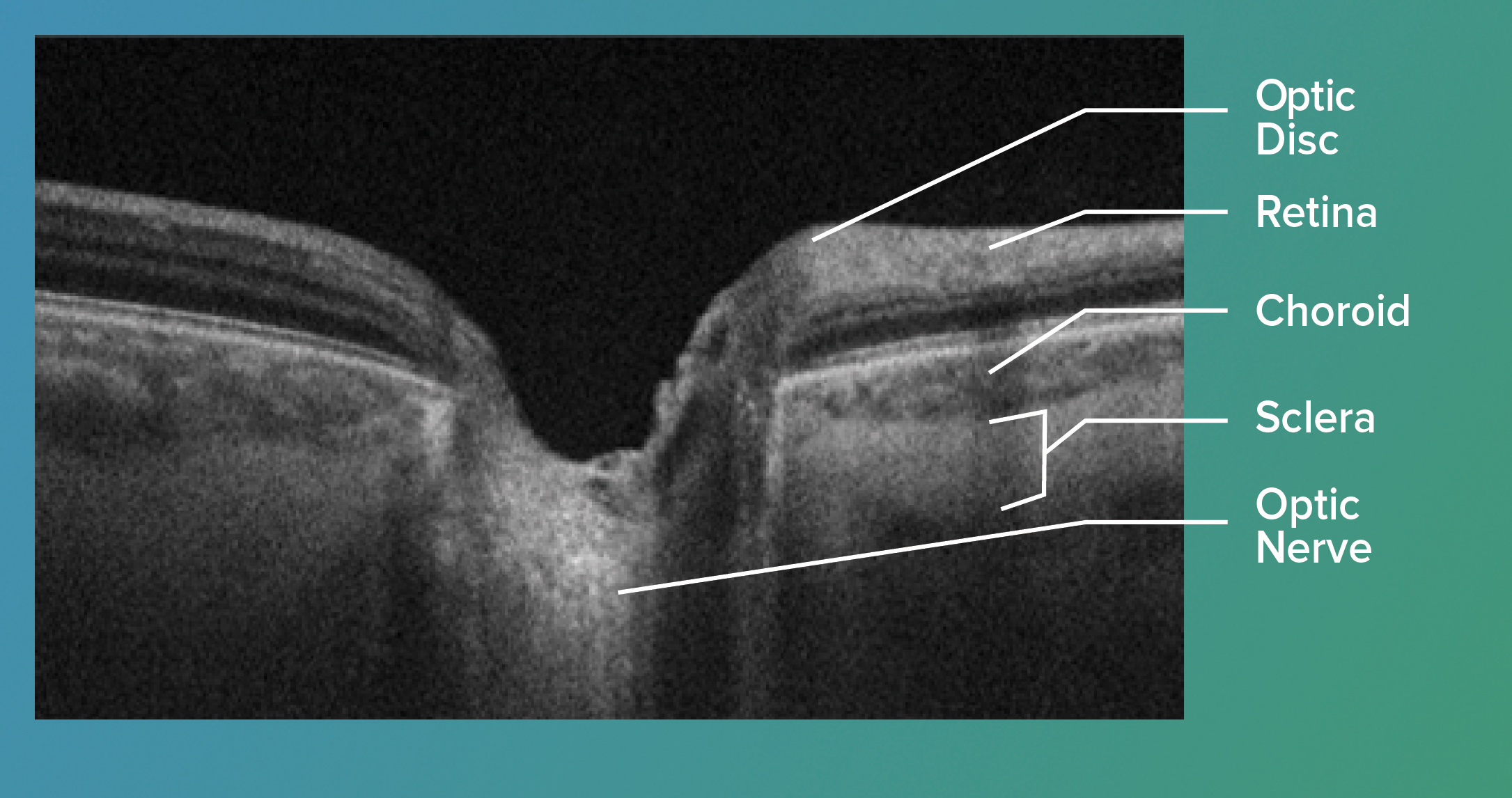 the-patient-s-guide-to-optic-nerve-drusen-eyedolatry